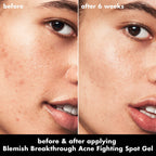 Blemish Breakthrough Acne Fighting Spot Gel