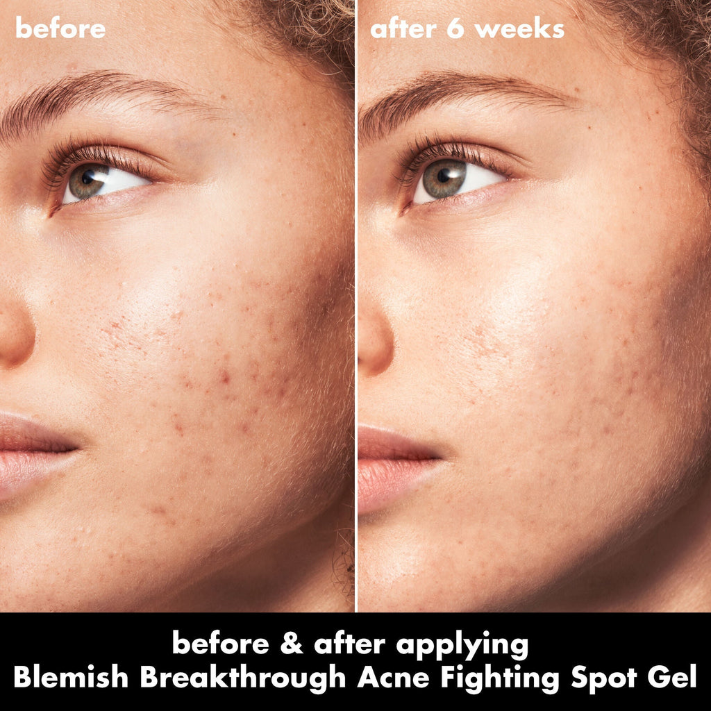 Blemish Breakthrough Acne Fighting Spot Gel